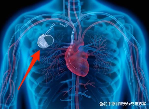 體內植入醫療電子產品無線充電方案的應用